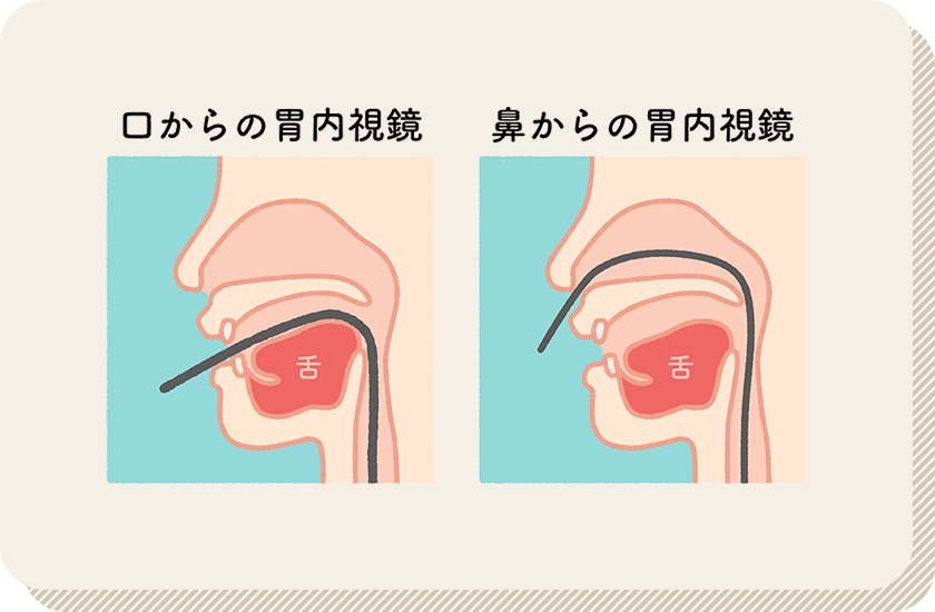 鼻と口どちらからでも挿入可