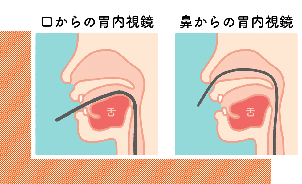 鼻と口どちらからでも胃カメラ検査が可能