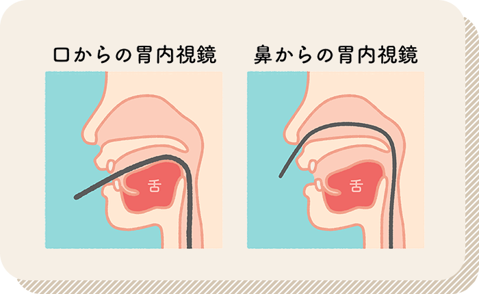 鼻と口どちらからでも挿入可