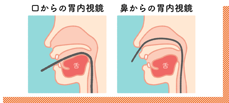 鼻と口どちらからでも胃カメラ検査が可能