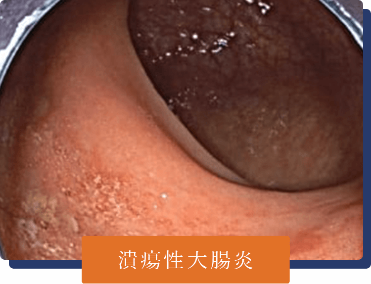 潰瘍性大腸炎